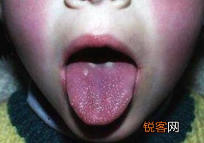 猩红热有什么特点 猩红热有哪些特别的表示