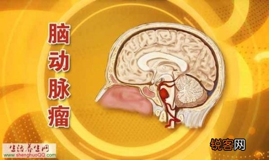 动脉瘤一不小心要你命！预防动脉瘤应该怎样做？