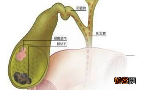 胆结石到胆囊癌仅有一步之遥！自觉“排石”能够引发胆囊癌