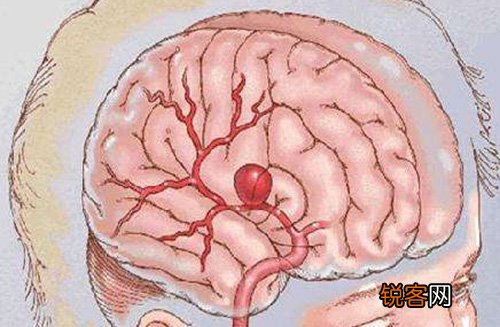 脑动脉瘤医治后生活中应留意什么？脑动脉瘤留意事项