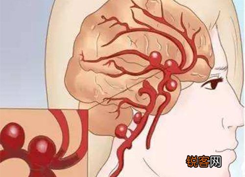 脑动脉瘤医治后生活中应留意什么？脑动脉瘤留意事项