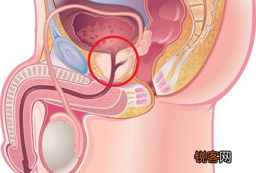 男人易得前列腺癌的5个特征 看看你占了多少