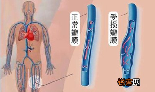 静脉曲张的早期有哪些罕见症状