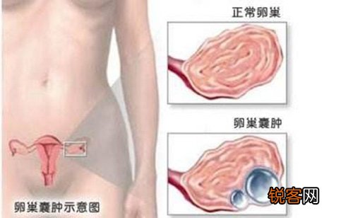 卵巢囊肿会本人好吗？生感性囊肿可自行消逝