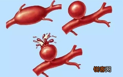 颅内动脉瘤的预防有哪些办法？三小气法需留意！