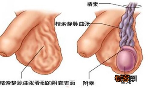 精索静脉曲张症状有哪些表示 初期认清症状很关键